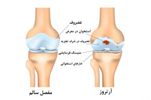 Osteoarthritis or arthrosis