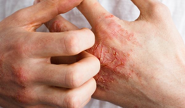 آرتریت پسوریازیس چیست؟
