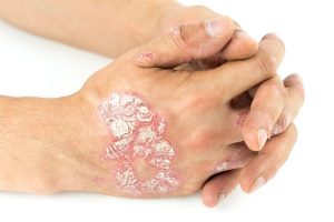 بیماری پسوریازیس (Psoriasis)