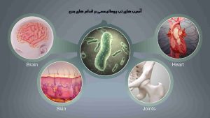تاثیر تب روماتیسمی