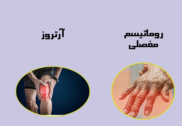 تفاوت بین روماتیسم و آرتروز