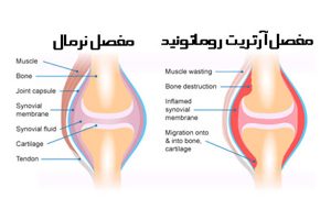 روماتیسم مفصلی