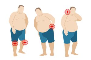 نحوه کاهش وزن در آرتروز