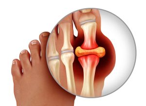 شایعات درباره نقرس