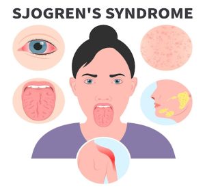 علائم سندروم شوگرن
