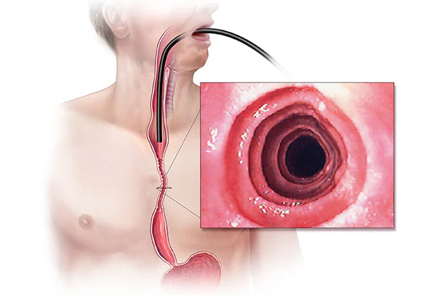 بیماری ازوفاژیت ائوزینوفیلیک (Eosinophilic esophagitis)