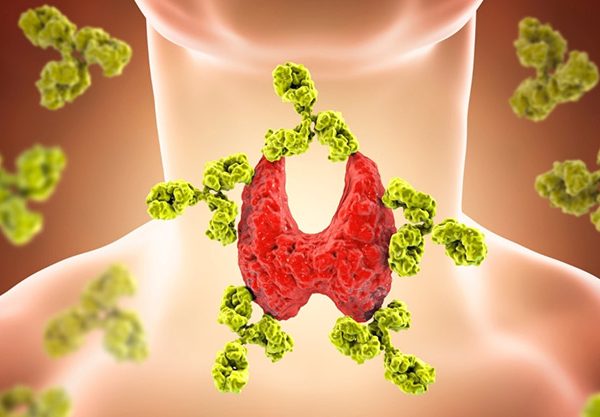 تیروئیدیت هاشیموتو (Hashimoto's Thyroiditis)