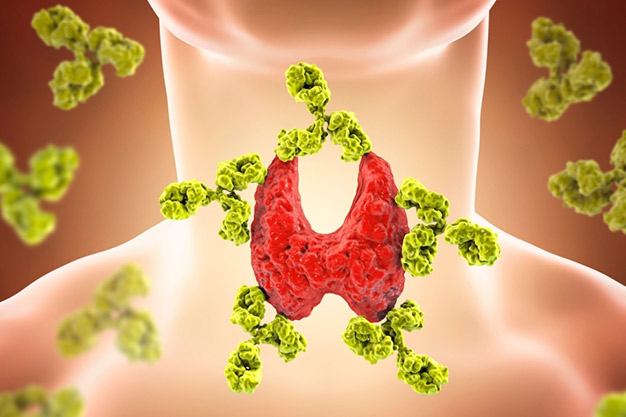 تیروئیدیت هاشیموتو (Hashimoto's Thyroiditis)