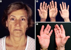 علائم بیماری آدیسون (Addison's Disease)
