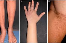 علائم سندرم آنتی‌فسفولیپید