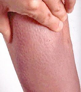 علائم بیماری گریوز