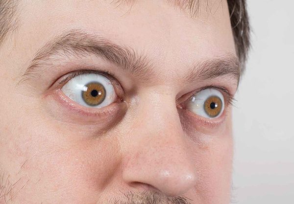 بیماری گریوز (Graves' Disease)