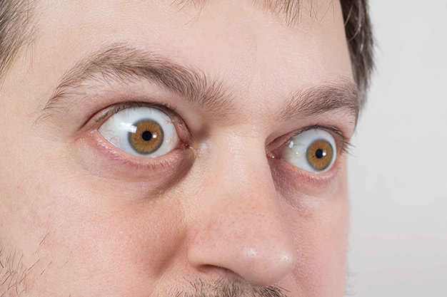 بیماری گریوز (Graves' Disease)
