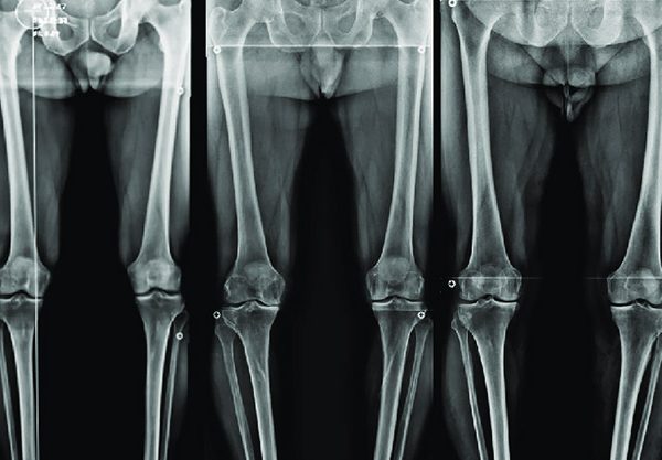 رادیوگرافی الایمنت (Alignment view x ray)