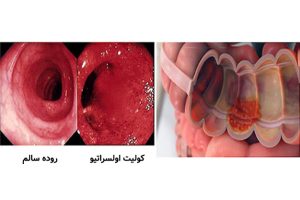 تشخیص بیماری کولیت اولسراتیو