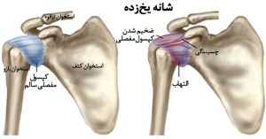 سندرم شانه یخ زده چیست؟