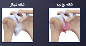 سندرم شانه یخ زده و شانه نرمال
