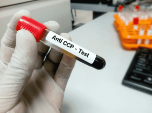 آزمایش Anti-CCP