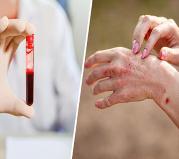 آزمایش روماتیسم مفصلی