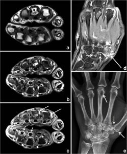 تشخیص آرتریت روماتوئید با MRI