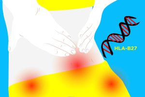 کاربردهای اصلی آزمایش HLA در روماتولوژی